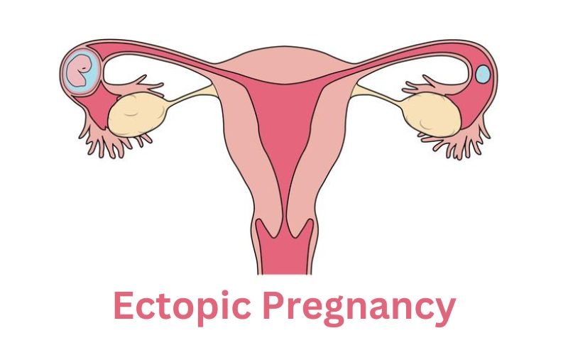 Ectopic Pregnancy: Symptoms Causes & Treatments